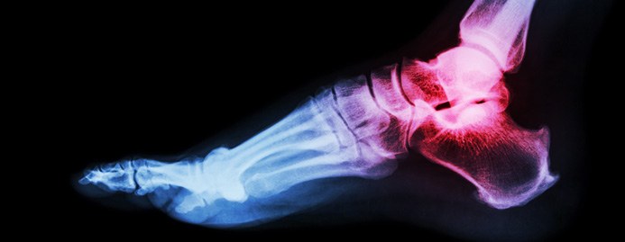 Radiograph of a fractured ankle — a trimalleolar fracture involves the lateral, medial and posterior malleoli